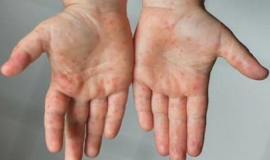 Kızamık vakalarında korkutan artış!