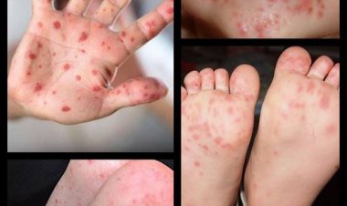 Ağız-el ayak Hastalığı artıyor