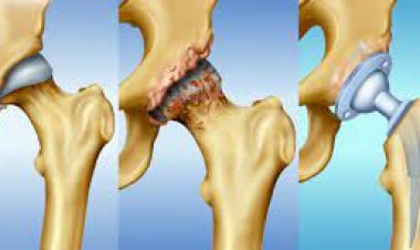Türkiye'de 200 bin kişi, kış mevsiminde kalçasını kırıyor