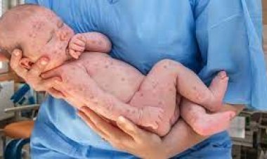 Kızamık vakalarında korkutan artış