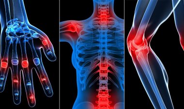 Uzmanı uyardı: Dizlerde ağrı, kireçlenme habercisi olabilir