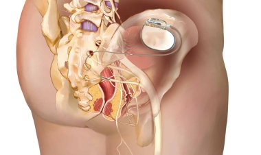 İdrar problemleri yaşayanlara ‘Mesane pili' tedavisi